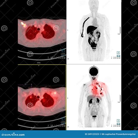 PET Scan Image of Thorax or Chest Comparison Axial , Coronal for Detect ...