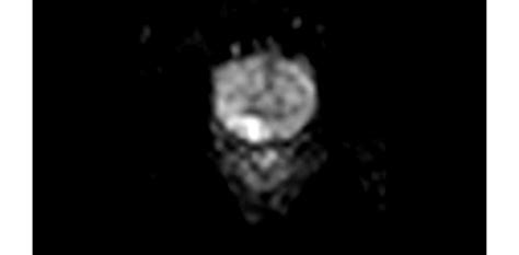 Philips - Diffusion - Pelvis MR clinical application