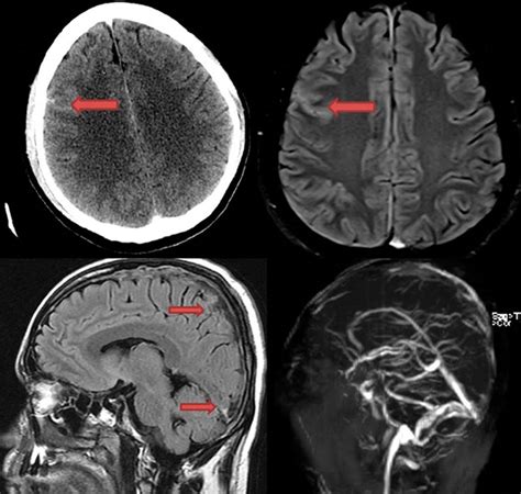 Subarachnoid Hemorrhage Mri