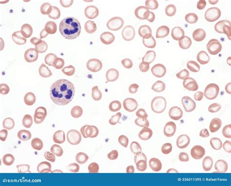 Iron Deficiency Anemia. Peripheral Blood. Stock Image - Image of anisocytosis, smear: 336011395