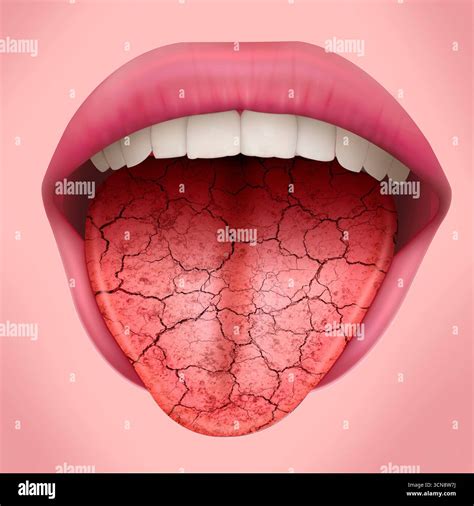 Cracked tongue in sjogrens syndrome hi-res stock photography and images - Alamy