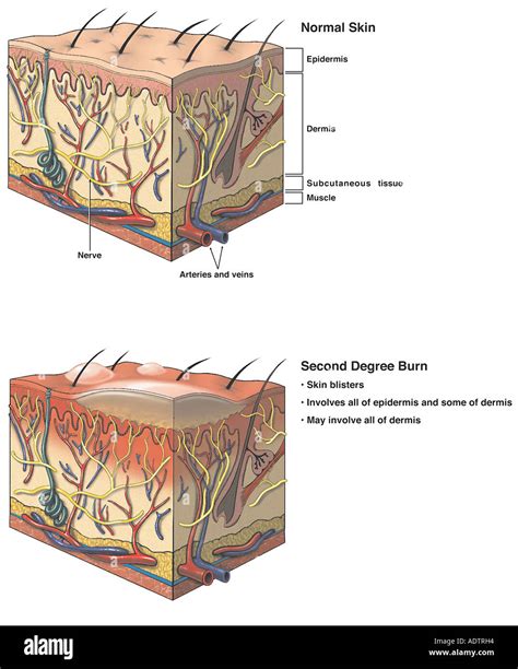 Primer Grado Quemaduras at Harry Northcott blog
