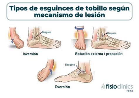 Cómo se tratan los Esguinces de tobillo? – FisioClinics Palma | FisioClinics Palma