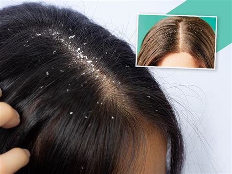 Scalp Dandruff 的图像结果