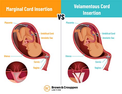 Marginal Cord Insertion: Causes, Risks, Treatment - Brown & Crouppen