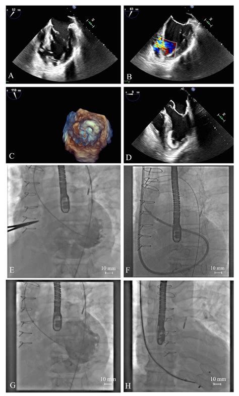 Complicating Acute Myocardial Infarction. Current Status and Unresolved ...
