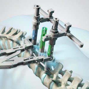 Image result for Spinal Fixation