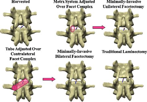 Lumbar Foraminotomy