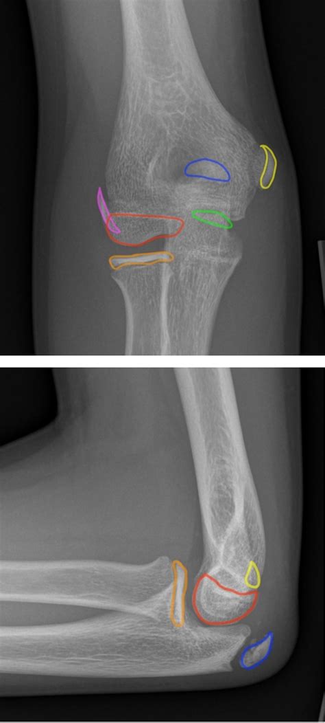 Pediatric Elbow | Radiology | U of U School of Medicine