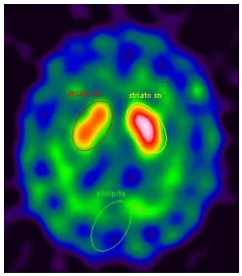 Development of Parkinsonism in a Patient with Central Pontine Myelinolysis