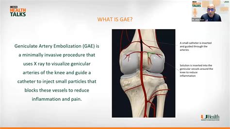Osteoarthritis of the knee - Geniculate Artery Embolization (GAE) | Excel Male TRT Forum