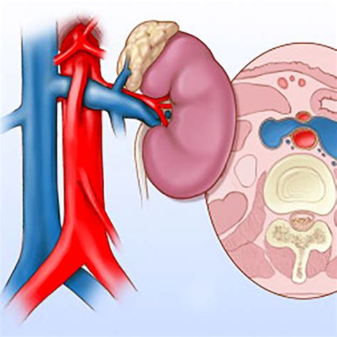 Nutcracker Syndrome Causes Nutcracker Syndrome: How To Diagnose It And