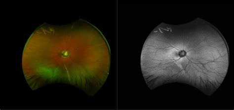 Morning Glory Syndrome Optic Nerve