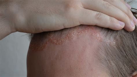 Sarpullido por VIH, ¿cómo reconocerlo? - Mejor con Salud