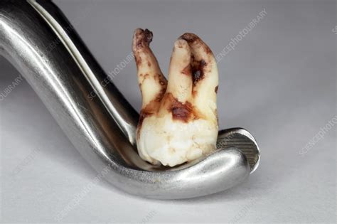 Extracted Wisdom Tooth 的图像结果