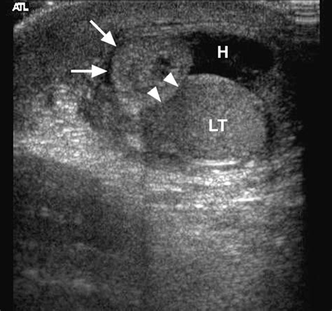Color Doppler Sonography of Normal and Torsed Testicular Appendages in Children | AJR