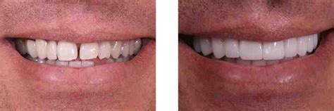 Cosmetic dentistry that accepts medicaid for dentures 2018 - Dental ...