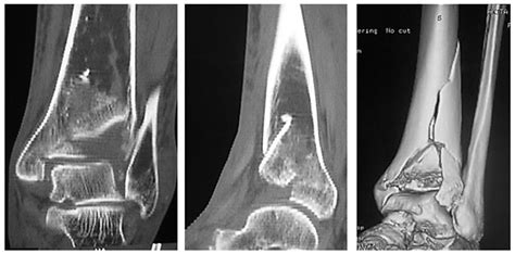 Pilon Fracture at Faith Fussell blog