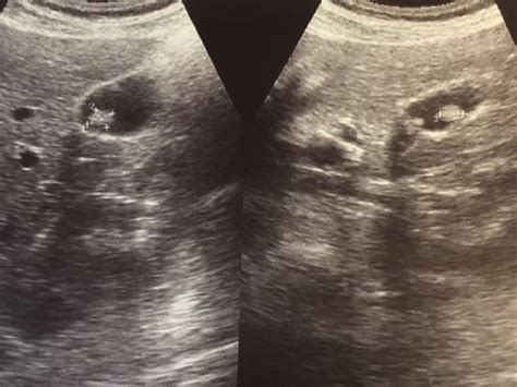 गाल ब्लैडर फ़ोटो और इमेज | Canva