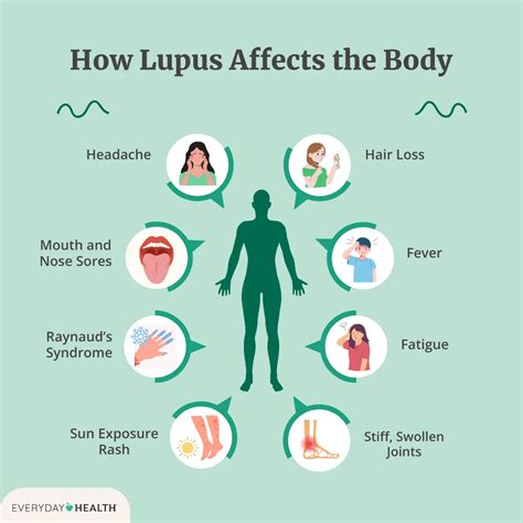 What Is Lupus? Symptoms, Causes, Diagnosis, and Treatment
