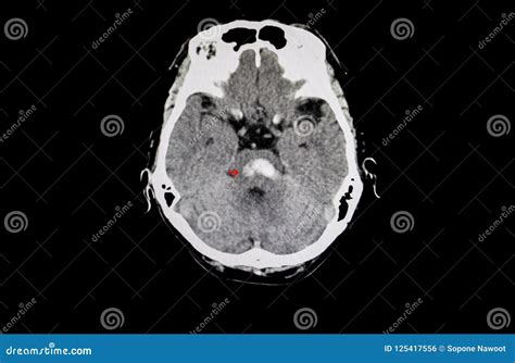 Hemorrhage In Pons