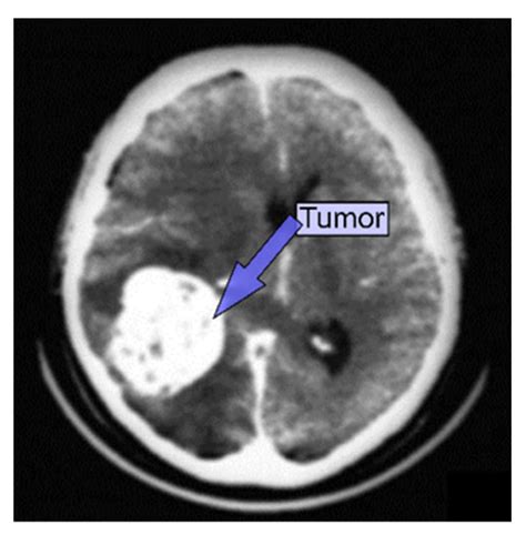 A Review of Recent Advances in Brain Tumor Diagnosis Based on AI-Based Classification