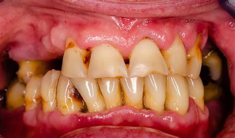 Periodontitis: Treatment, symptoms, causes | CURAPROX