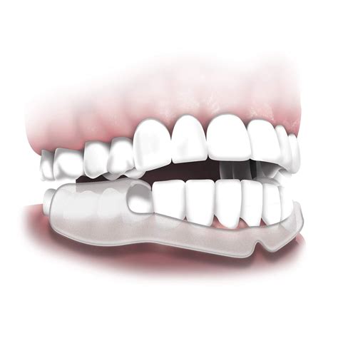 Plackers Grind No More Dental Night Guard for Teeth Grinding - 14 Count ...