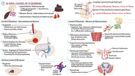 USMLE / COMLEX - Step 3: GI Pathology: Bleeding | Draw It to Know It