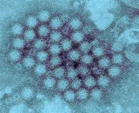 What to Know About Norovirus and How to Treat It | TIME