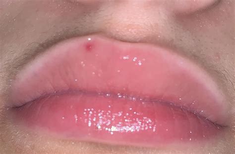 Pls help I have this little red dot on my lips it’s been there for two months, no itchiness no ...