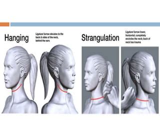 Image result for Postural Strangulation