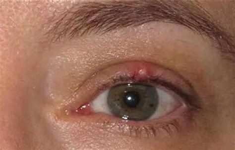 眼睛下眼睑红肿疼痛 眼皮红肿疼痛是怎么回事?_第二人生