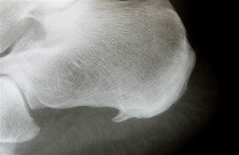Heel Spur Surgery: Preparation, Recovery, Long-Term Care