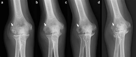 Image result for Elbow Cysts Explode