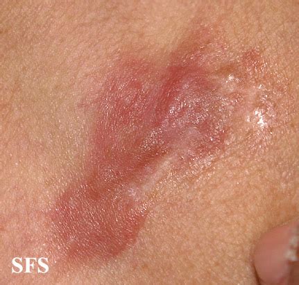 Image result for Dermatofibrosarcoma Protuberans