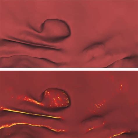 Image result for Polyp Detection Device