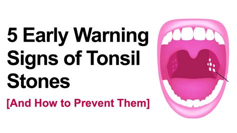 5 Early Warning Signs of Tonsil Stones (And How to Prevent Them)