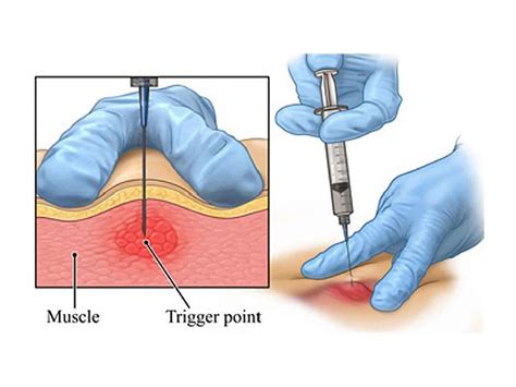 Trigger Point Injections 的图像结果