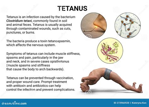 Fused Tetanus Definition Anatomy at Monte Stock blog