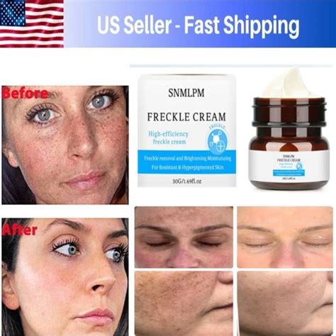 Melasma Freckle Removing Cream, Whitening Skin, | Ubuy India