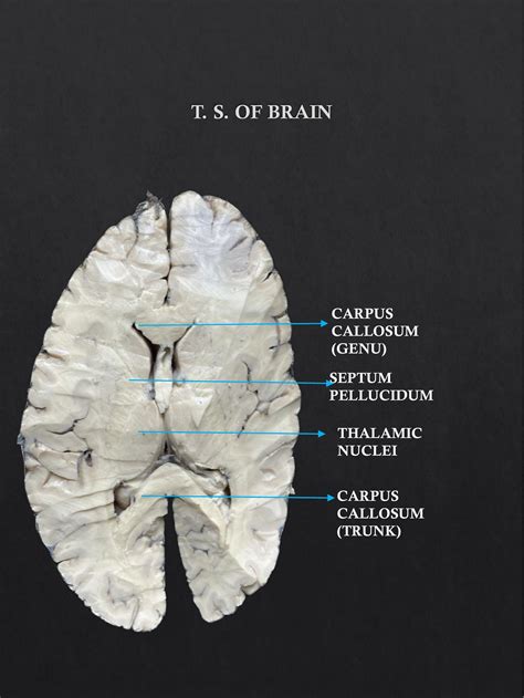 Transverse Section( TS) of Brain | NAMO Medical Education & Research ...