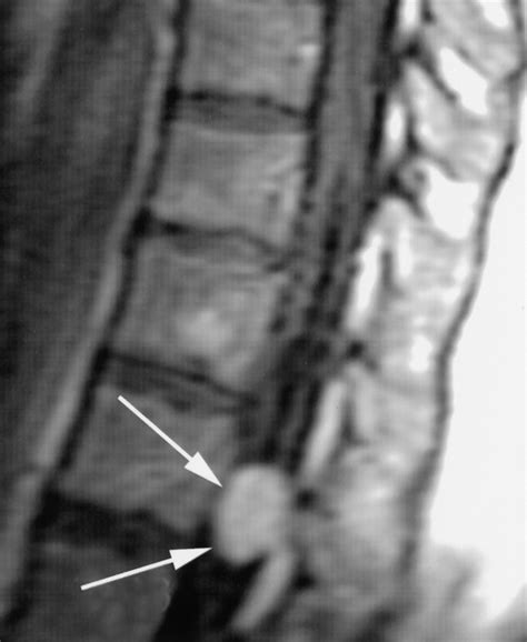 Neoplasms of the Spinal Cord and Filum Terminale: Radiologic-Pathologic ...