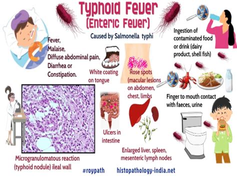 TYPHOID FEVER|SDCINDIA