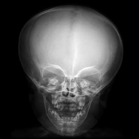 Head X Ray Child at Bill Eley blog