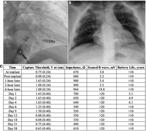 Acute increase in pacing capture threshold and impedance post–leadless ...