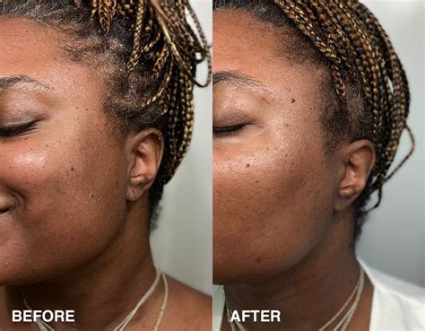 How to Use DermaFlash 的图像结果