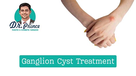 Ganglion Cyst removal - topplasticsurgery