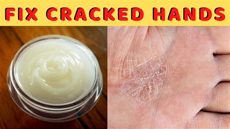 How To Fix Dry Cracked Hands Overnight at Oscar Godson blog