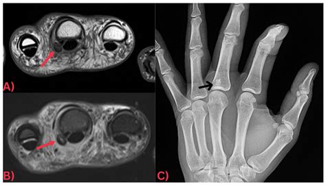 Hydroxyapatite Deposition Disease: A Comprehensive Review of ...